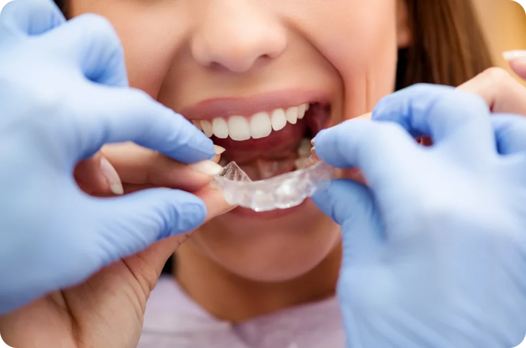 Orthodontie invisible, Orthodontiste Poussan 34560