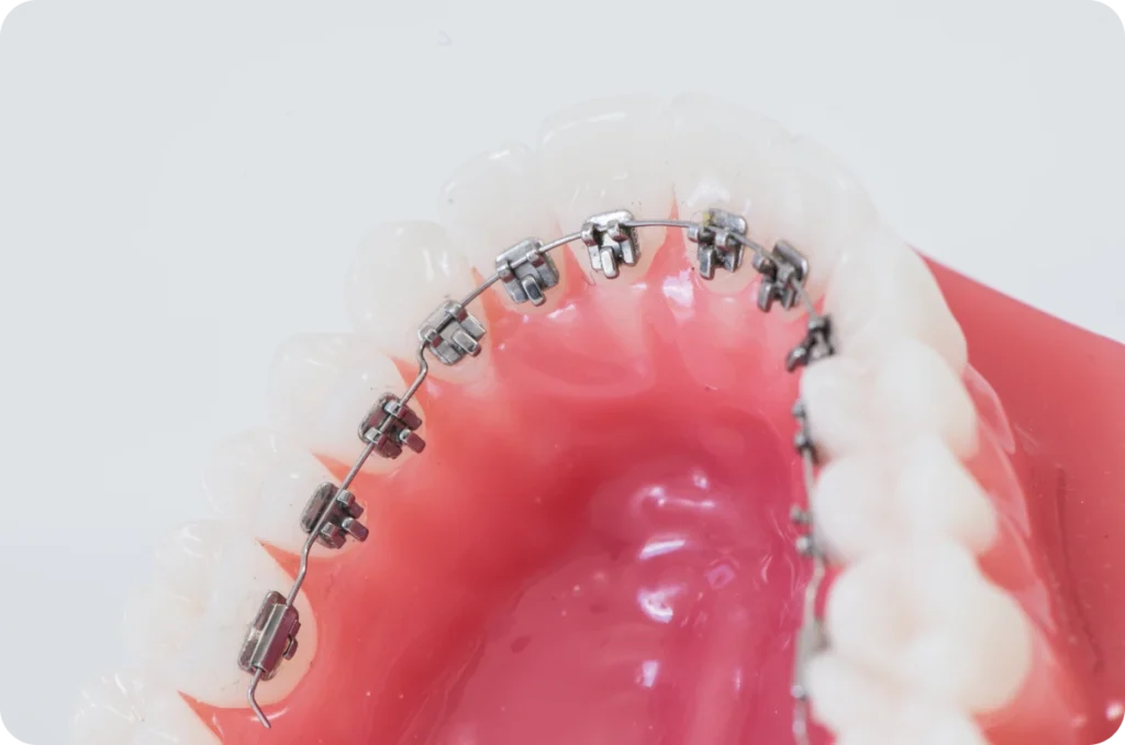 Orthodontie invisible, Orthodontiste Poussan 34560