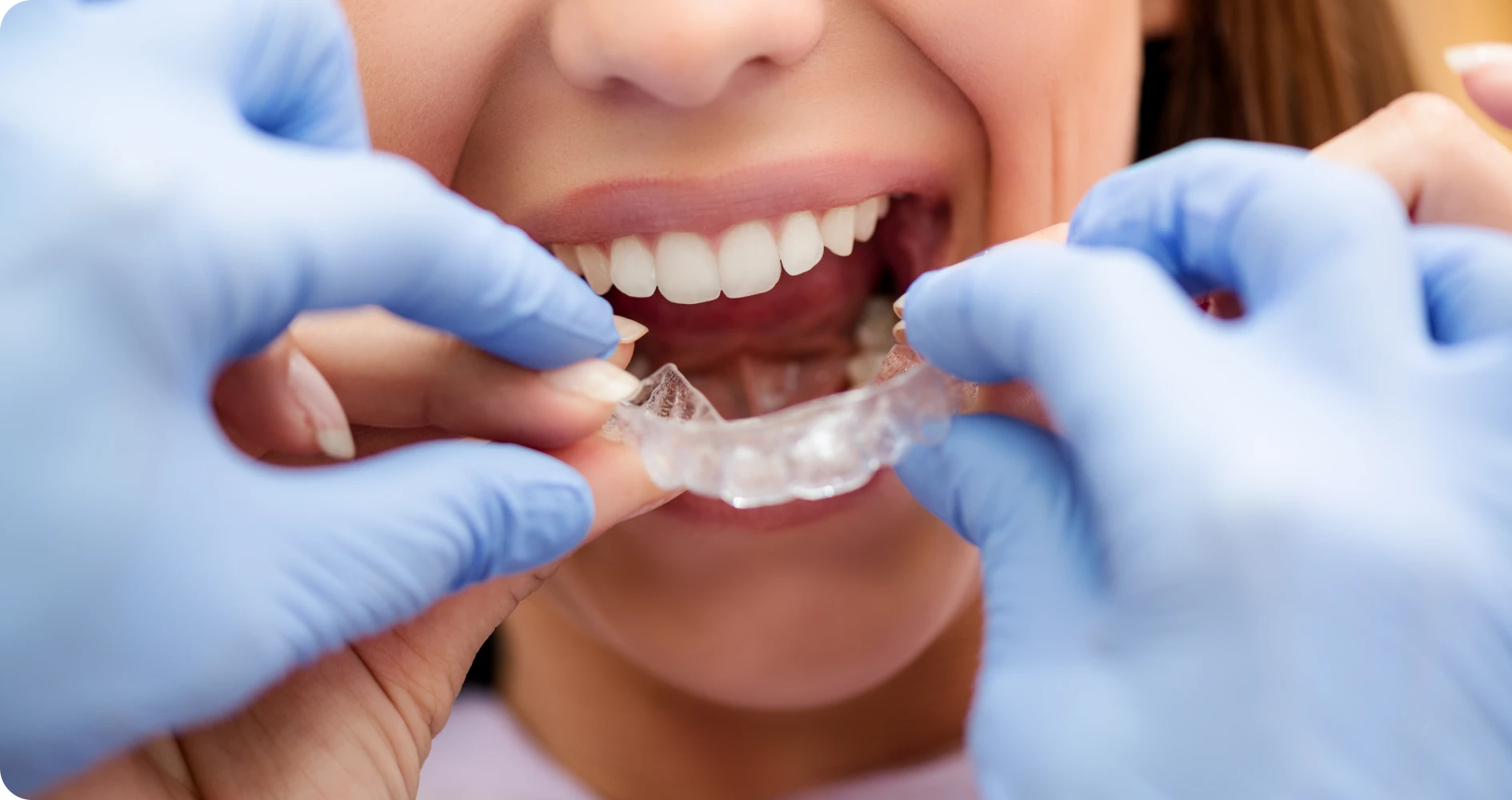 Orthodontie invisible à Poussan 34560