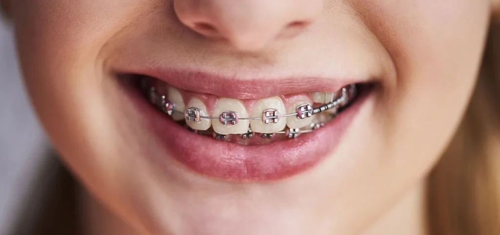 orthodontiste enfant Poussan 34560