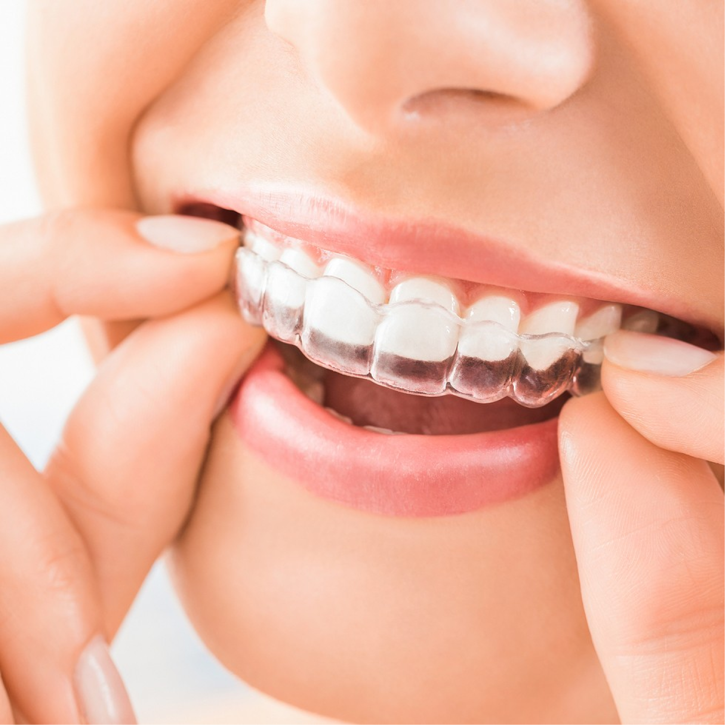 Quand consulter un orthodontiste ? orthodontie poussan