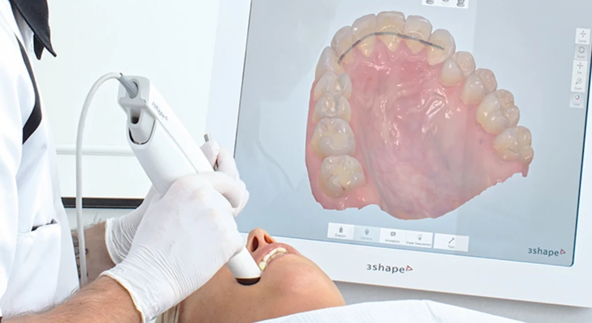empreinte-numerique-dentaire-orthodontie-poussanwebp